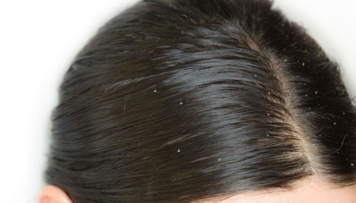 tips khắc phục tóc bết mùa hè