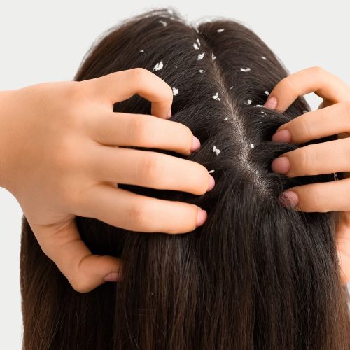 Thanh tẩy giảm gàu khi trời nồm