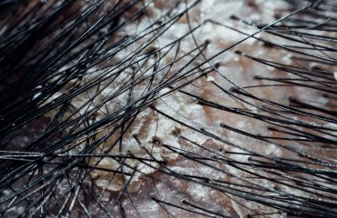 tips trị ngứa da đầu mùa hè
