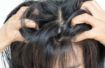 Da đầu tích tụ kim loại nặng