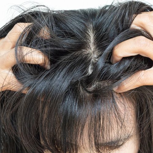 Da đầu tích tụ kim loại nặng