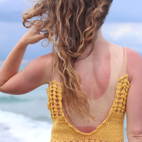 Tóc bị cháy nắng mùa hè