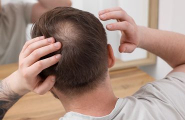 Cách trị hói đầu ở nam