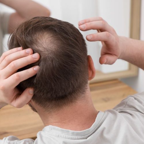 Cách trị hói đầu ở nam