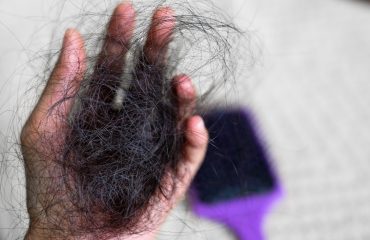 rụng tóc sau sinh